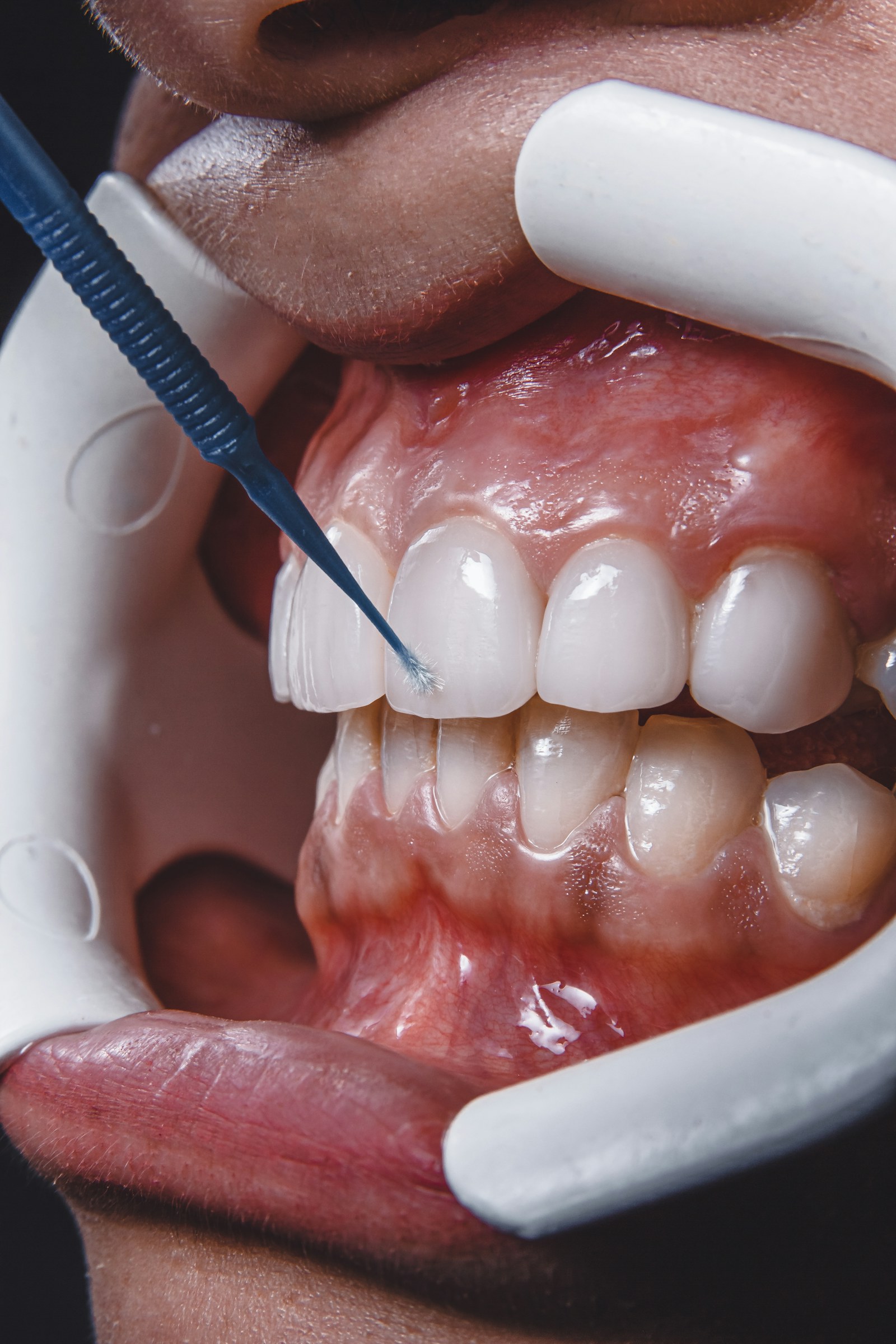 Instrument dentar care modelează suprafața dinților frontali