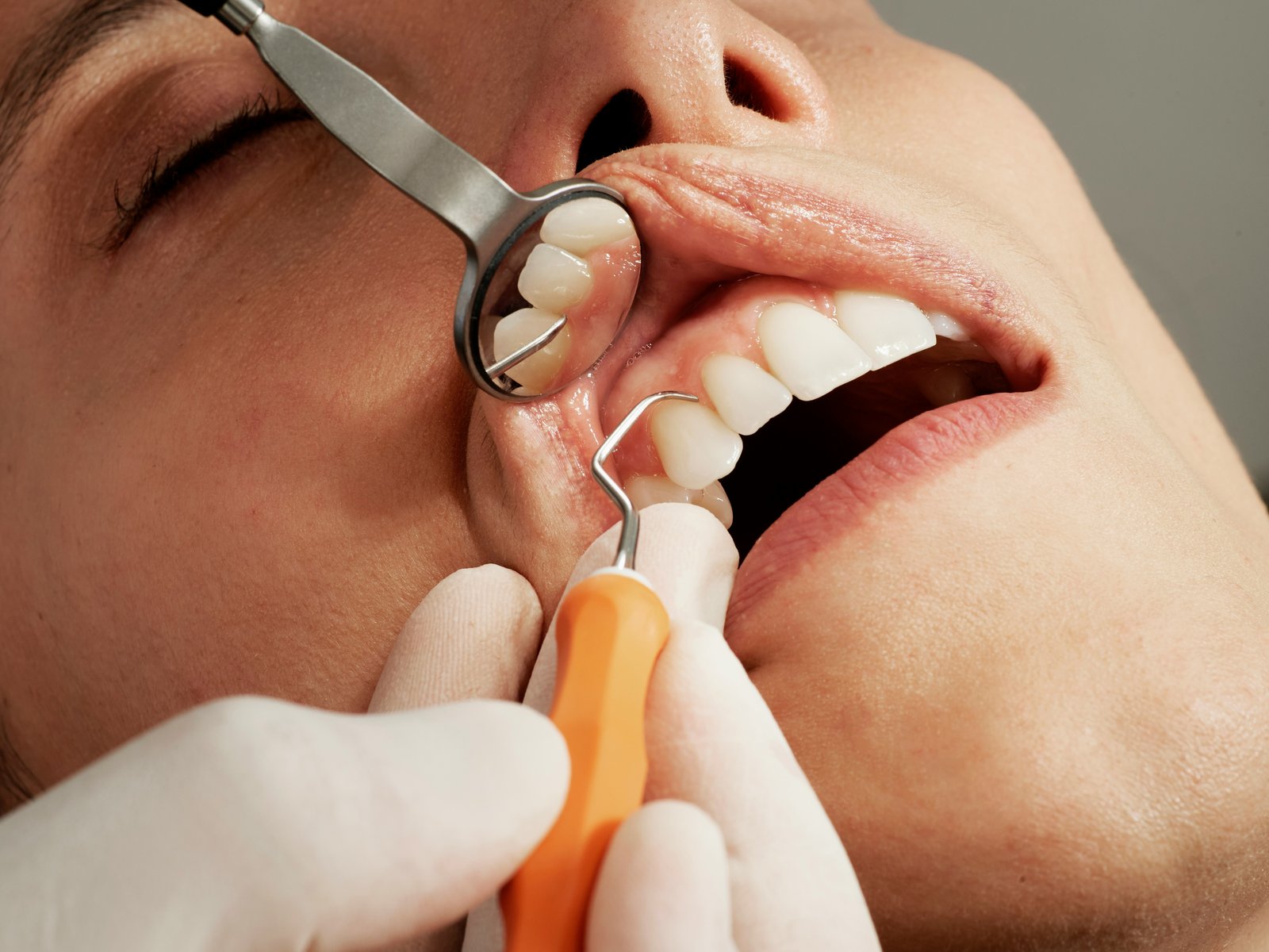 Examinare dentară cu oglindă și sondă